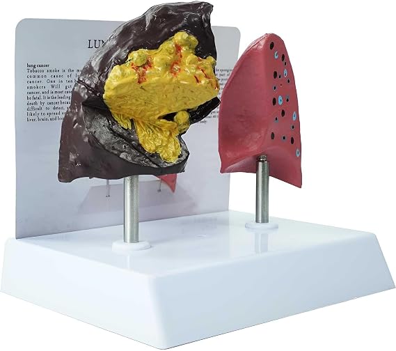Smoker's Lung vs Healthy Lung Comparative Model - Life Size Anatomical Display for Medical Education, Respiratory Health Study Tool with Pathological Features, PVC Structure